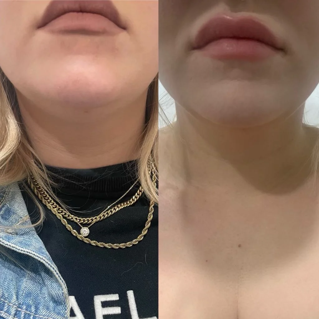 Belkyra-double-chin.webp