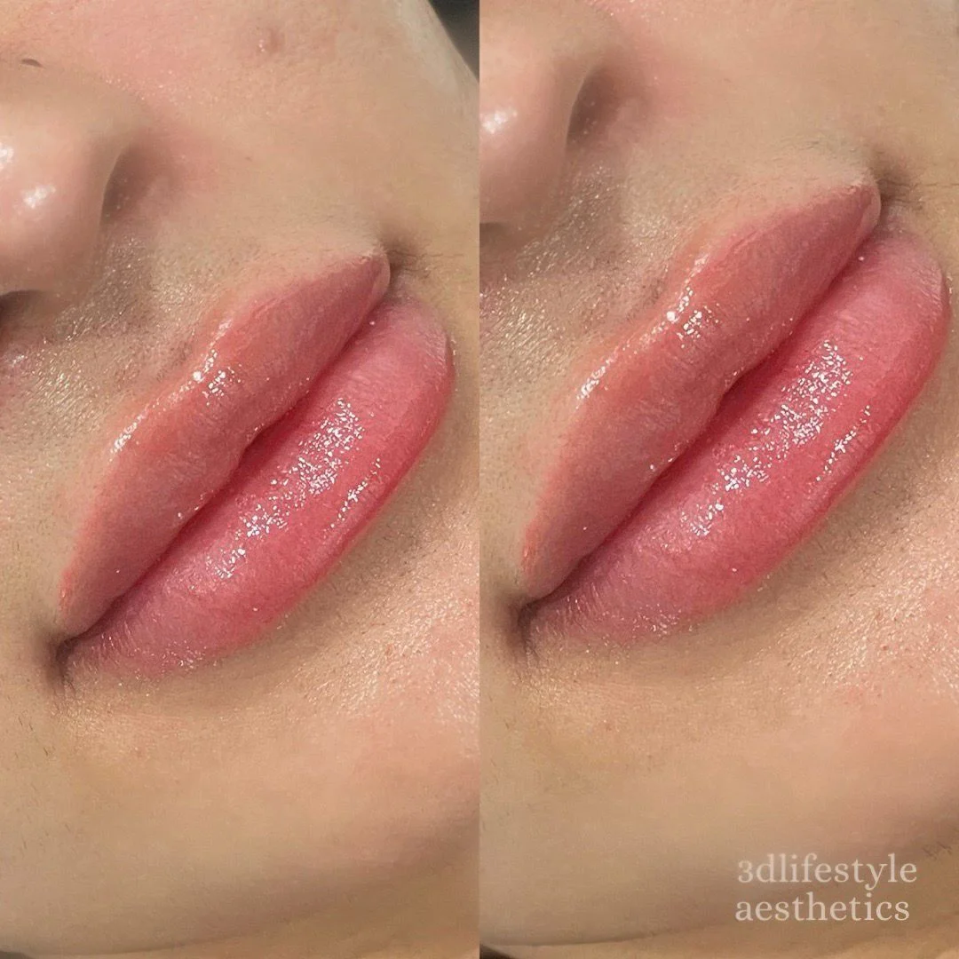 lip-fillers-10.webp