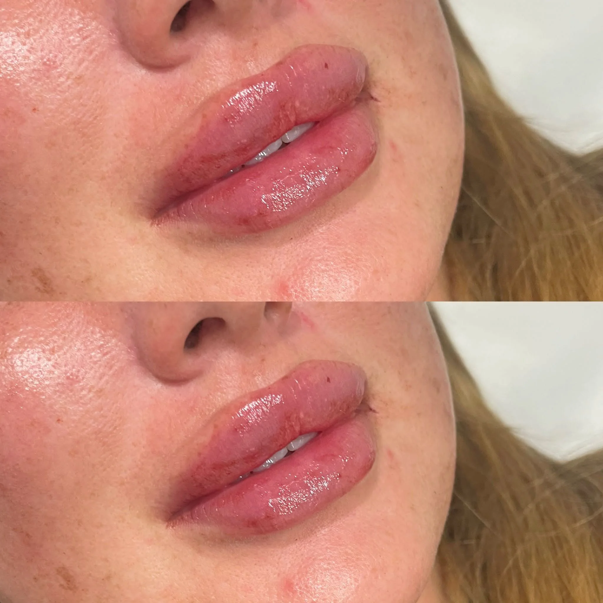 lip-fillers-4-1.webp